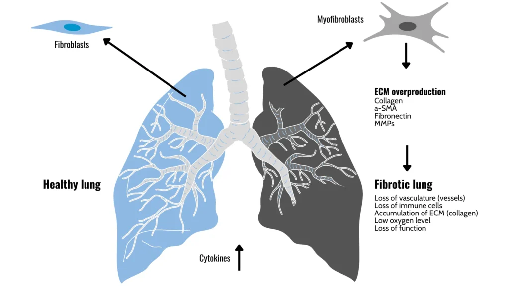 A diagram comparing a healthy lung to a fibrotic lung. The healthy lung has clear airways and blood vessels, while the fibrotic lung has thickened airways, reduced blood vessels, and inflammation.